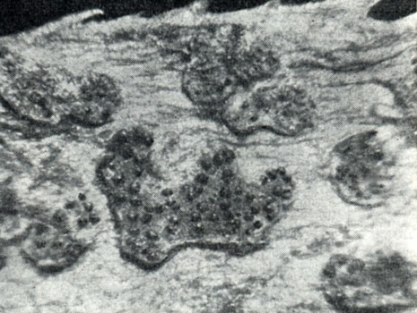 Рис. 268. Пикниды гриба дарлюка нитчатая (Darluca filum) в уредопустуле ржавчины