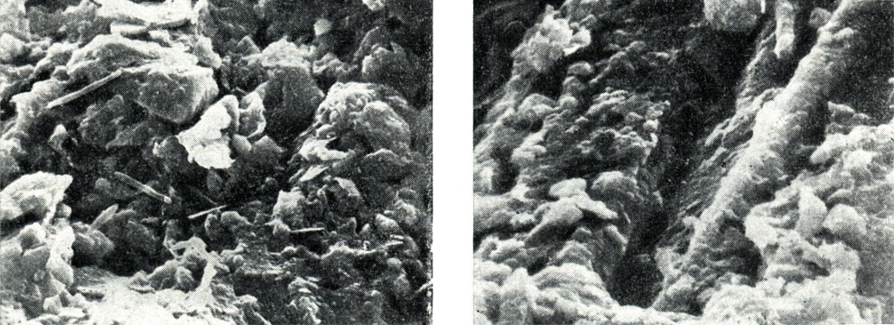 Рис. 120. Микроструктура микробных очагов (фото в сканирующем электронном микроскопе). Увел. X 1600
